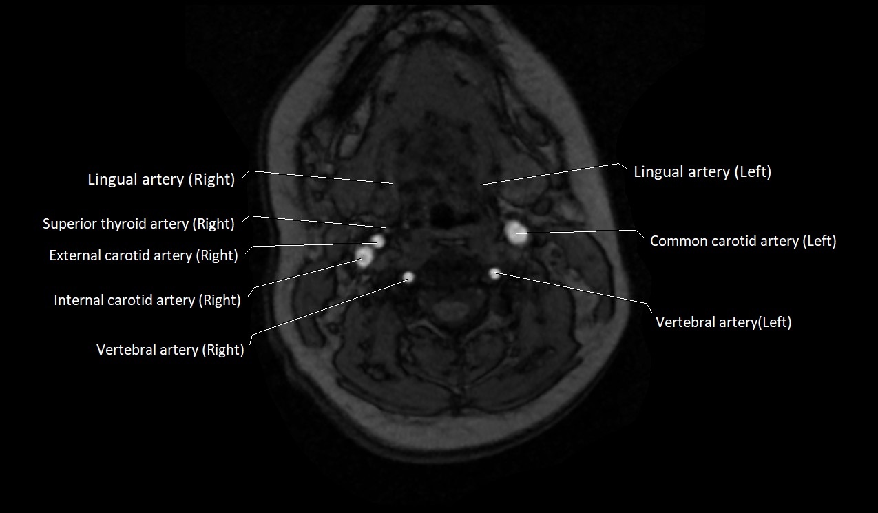 Carotid artery anatomy axial 3T image 28.jpg